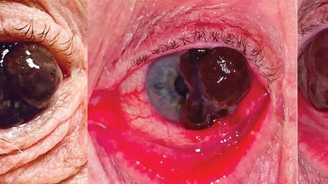 Conjunctival Melanoma