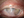 Figure 1. Severe limbal stem cell deficiency in the left eye of a 60-year-old patient.