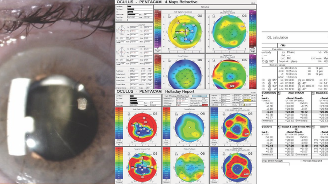 A Novel Technique for Closing a Cataract Incision