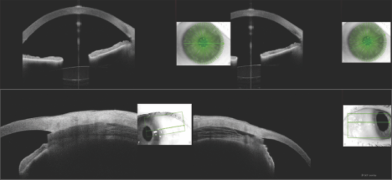 The Role of Anterior Segment OCT in MIGS