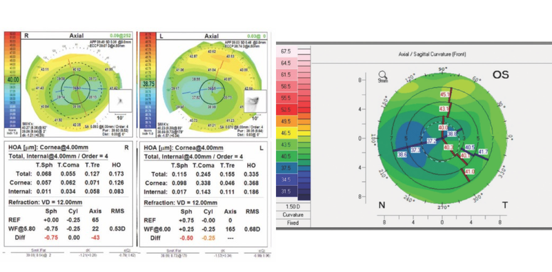 Achieving Spectacle Independence After LASIK