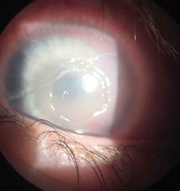 A Complex Case of Treatment Resistant Pediatric Neurotrophic Keratitis