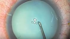 I Dont Have a Femtosecond Laser What Strategies Work Best for a White Cataract