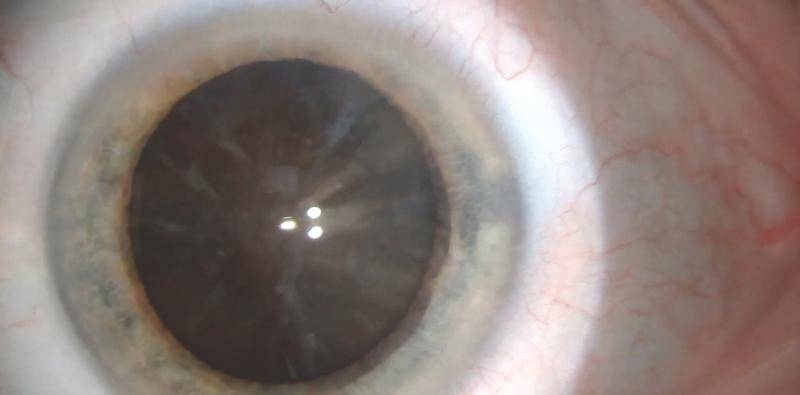 Dense Brunescent Unilateral Cataract