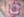 Figure 3. A Busin glide and 23-gauge forceps areused to insert an 8.5-mm endothelial graft into the anterior chamber.