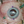 Figure. Subluxated IOL–capsular bag complex with Soemmering ring in a patient with PXF syndrome.