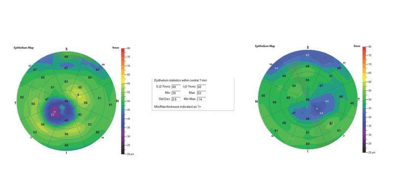 Epithelial Thickness Mapping for the Detection and Management of Corneal Irregularities