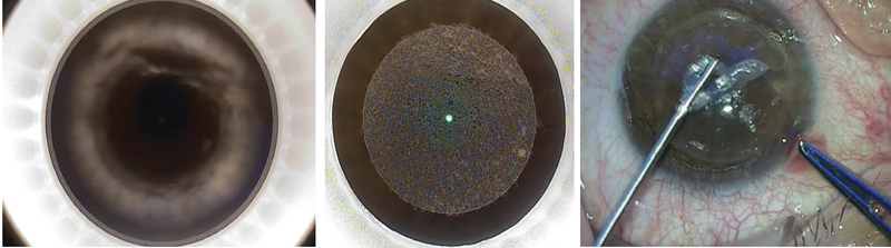 Refractive Surgery Mayday