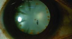 Intralenticular Iron Foreign Body With Lens Siderosis