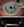 Figure. Uveitis-glaucoma-hyphema (asterisk indicates hyphema) syndrome (A) caused by a one-piece IOL that resides partially in the sulcus (arrow), as confirmed on ultrasound biomicroscopy (B).