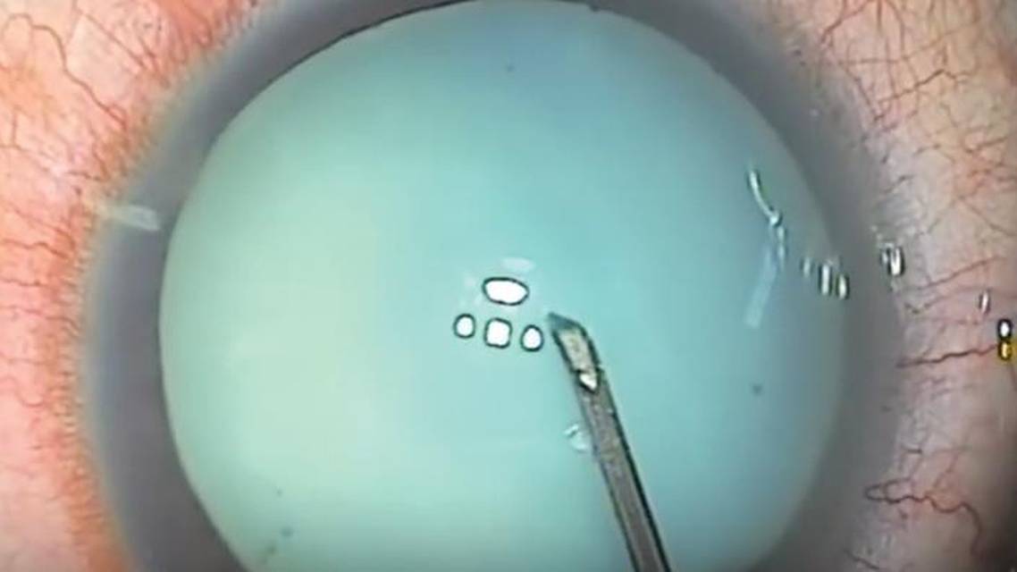 I Dont Have a Femtosecond Laser What Strategies Work Best for a White Cataract