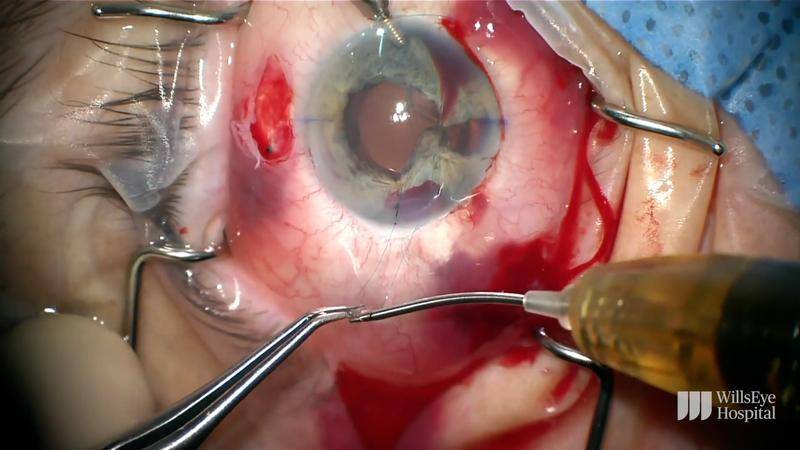 Yamane Technique and Iris Repair in Case of Trauma thumbnail