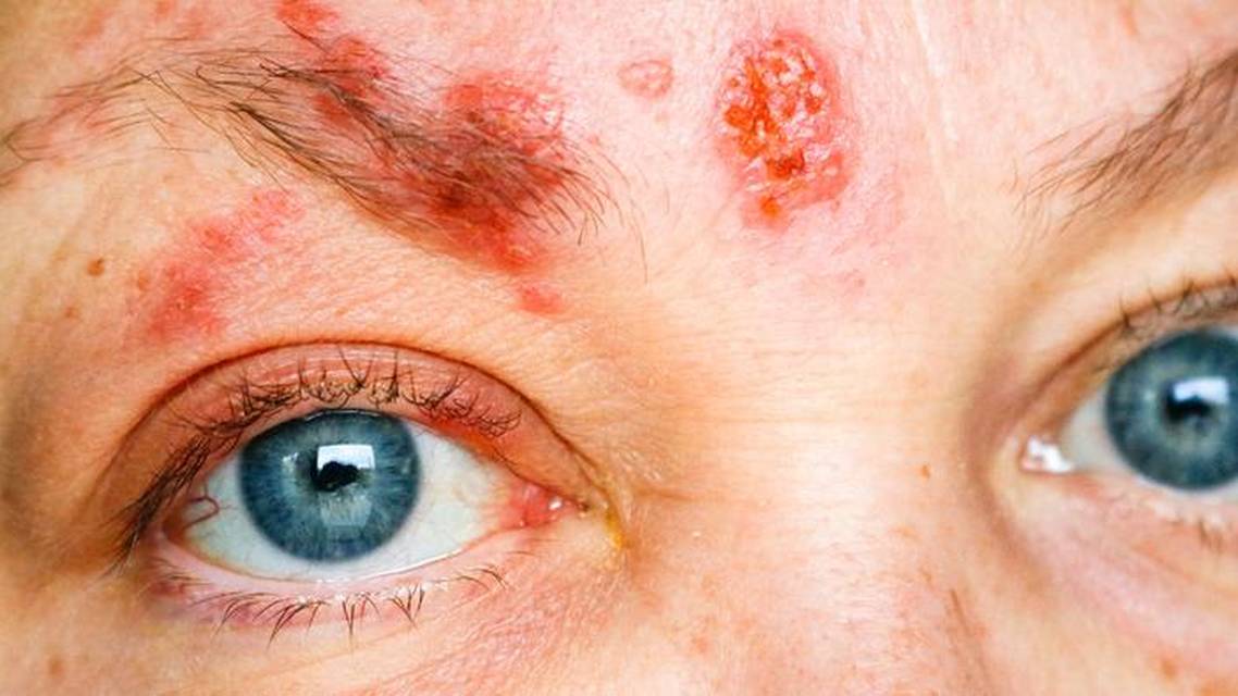 Update on the Zoster Eye Disease Study