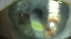 Expanding Options for Persistent Corneal Ulcer