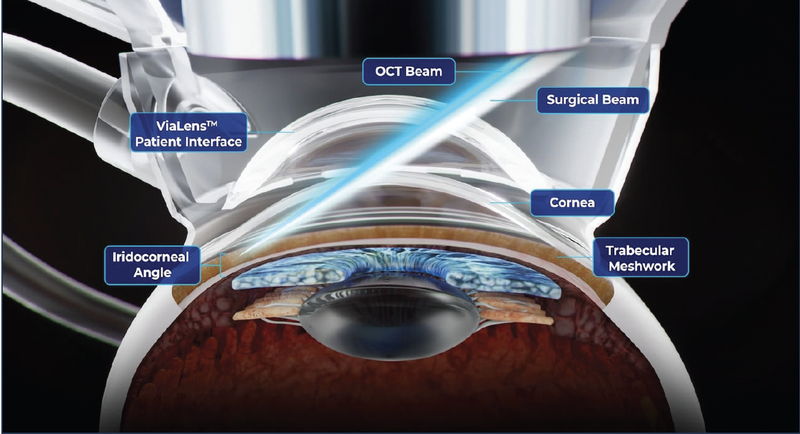 FLIGHT Femtosecond Laser Image Guided High Precision Trabeculotomy