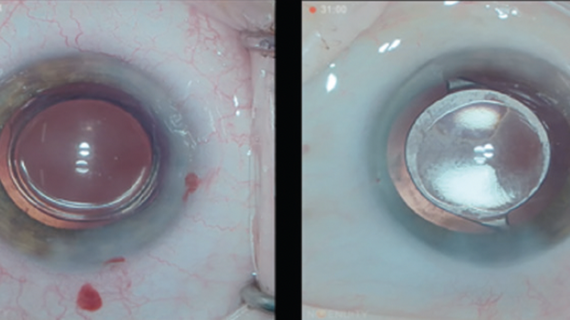 The New ZEISS CT LUCIA 621P IOL