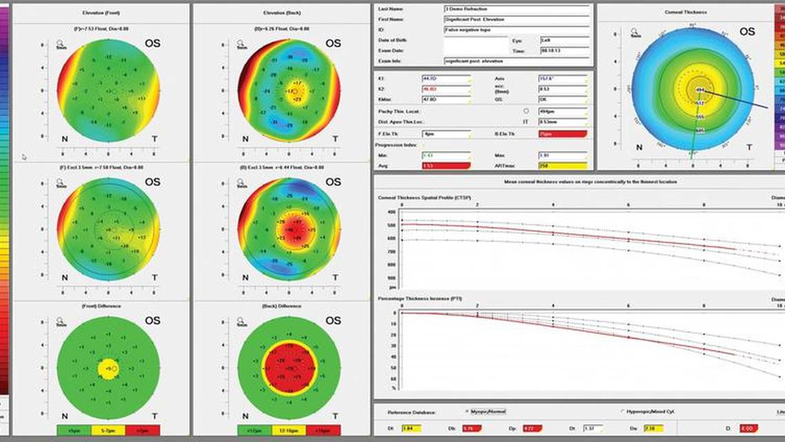 Keratoconus Pediatric Prevalence and a New Treatment Option