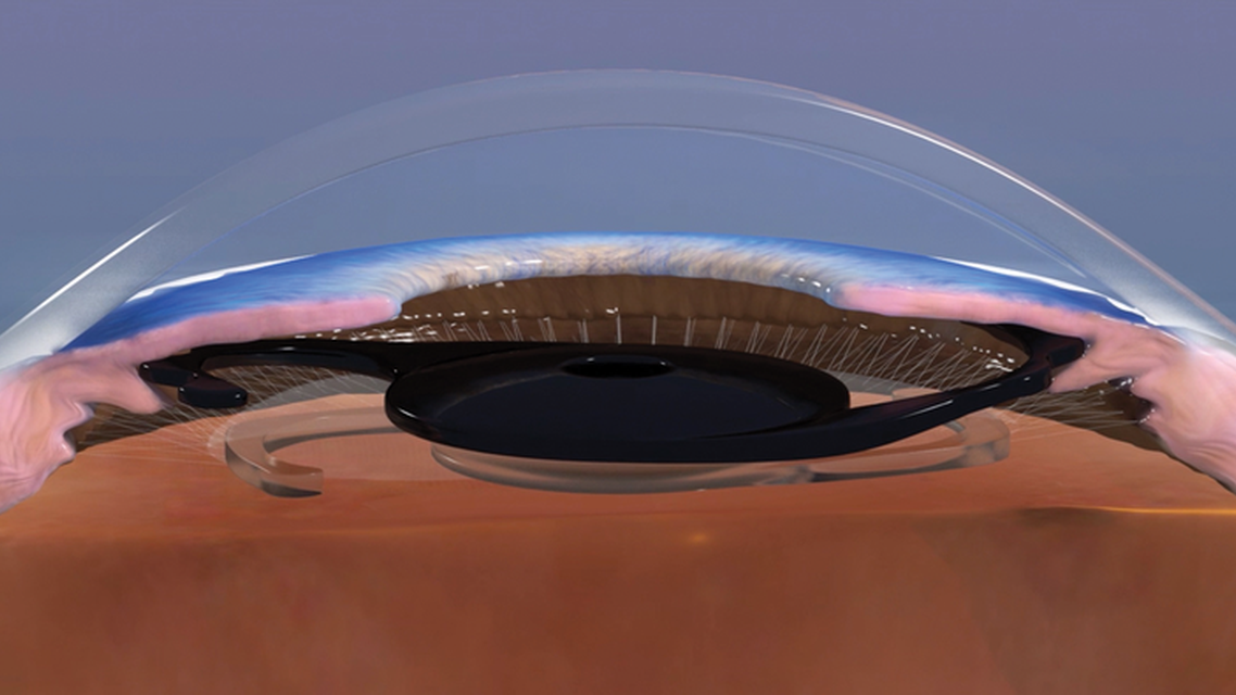 Pinhole Implant for Management of Irregular Astigmatism