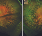 IOL Subluxation in the Presence of Retinal Disease