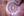 Figure 12. A 10-0 polypropylene suture on a curved
needle was used to make an iridoplasty to re-create the
pupillary border.