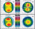 High Myopic Astigmatism