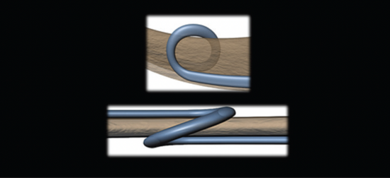 The Development and Impact of the Malyugin Ring