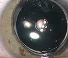Off Label Use of Femtosecond Laser for Posterior Capsulotomy