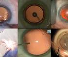 The European Perspective Innovation Simplifies Routine Cataract Surgery