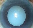 Morgagnian Cataract Presents Technical Challenges