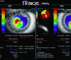 Contact Lens Intolerance After CXL