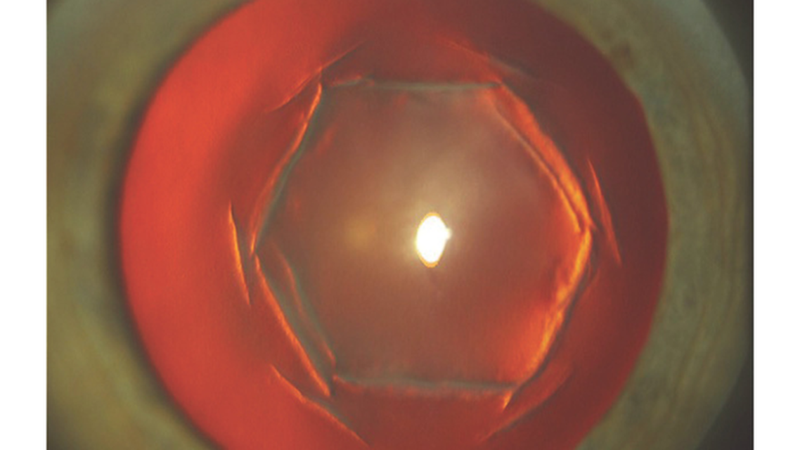 Poor Vision After Hexagonal Keratotomy