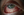 Figure 2. A 1-mm hypopyon evident on initial presentation.