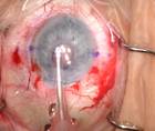 Corneal Edema in the Context of an Anterior Chamber IOL thumbnail