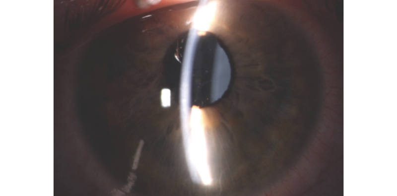 Excessive Vaulting of a Phakic IOL