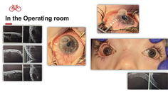 A Unique Case of Moraxella Keratitis in Moebius Syndrome