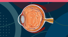 Best Practices on Referring Patients With Symptomatic Vitreous Opacities