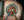 Figure 2. With an irrigating handpiece and a 19-gauge
phaco needle, the nucleus is sculpted in three passes.