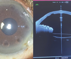 Atypical Corneal Flattening