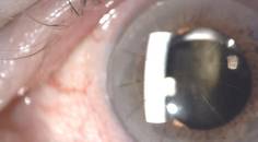 Worsening Vision From a Dislocated IOL