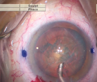 Low IOP Cataract Surgery