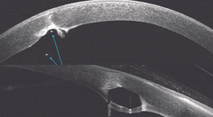 Intrastromal Corneal Ring Segment Erosion Into the Anterior Chamber