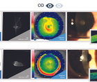 Customized Treatments for Patients With Poor Visual Acuity