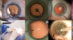 The European Perspective Innovation Simplifies Routine Cataract Surgery