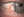 Figure 1. Baseline external photograph highlighting gelatinous lesion temporally along the conjunctiva.