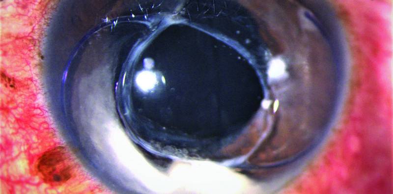 IOLCapsular Bag Complex in the Anterior Chamber