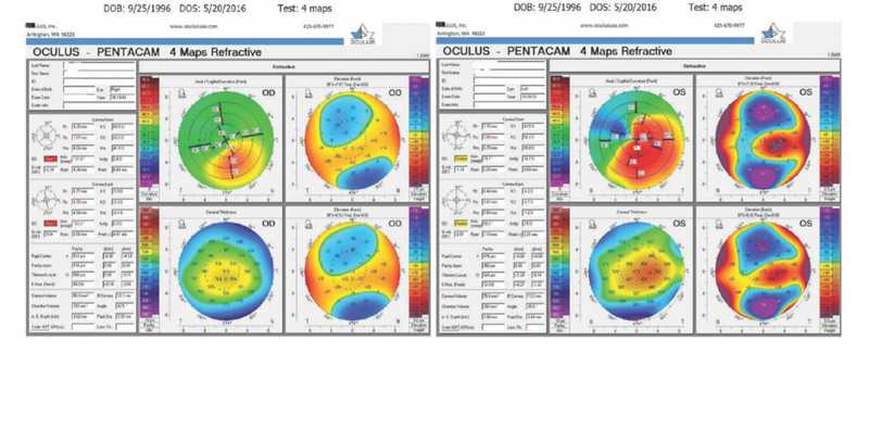 Legal Liability Issues in Keratoconus