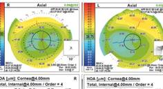 Is This the Perfect Candidate for Refractive Surgery