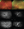 Figure 3. A 46-year-old man with a history of type 1 diabetes presented to the Wills Eye Hospital Retina Service. He had recently undergone bilateral cataract surgery with the implantation of a monofocal IOL. An adequate view to the posterior pole and periphery demonstrated PDR with high-risk features. Note the importance of intravenous fluorescein angiography for demonstrating the full extent of disease. Anti-VEGF injections and panretinal photocoagulation were initiated. Figures 3 and 4 courtesy of Saagar A. Pandit, MD, MPH
