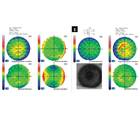 Visually Significant Cataract in the Presence of Corneal Disease