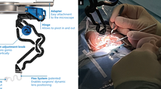 GONIO ready A New Gonioscopy System That Could Improve Your Surgical Approach With MIGS